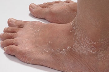 dermatitis