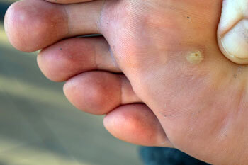 wart removal